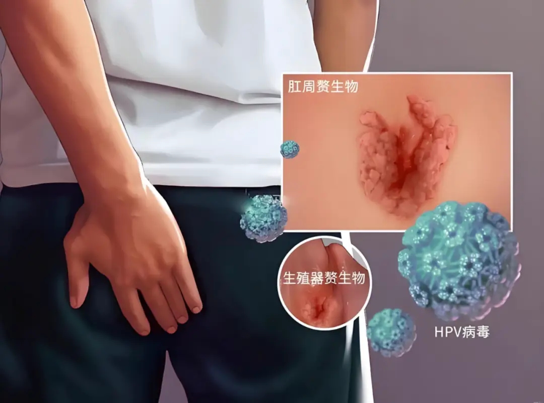 HPV男性感染风险更高！医生示警，恐引发6种癌症