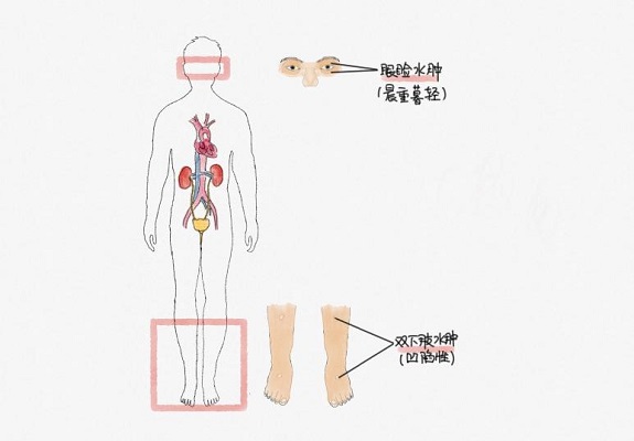 一文读懂“水肿”