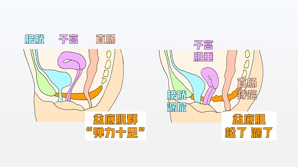 关爱女性健康 从盆底康复做起