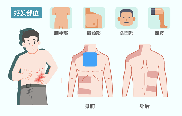带状疱疹防治知识你问我答