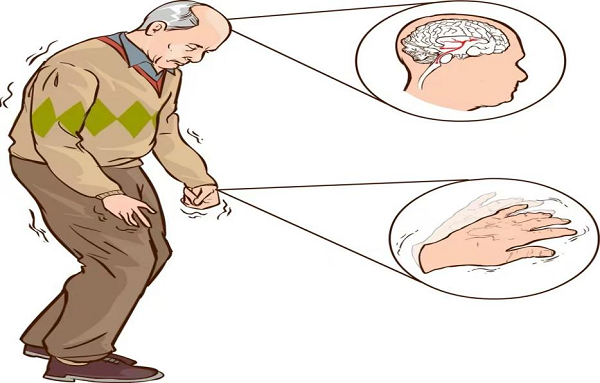 手抖一定是帕金森病吗？