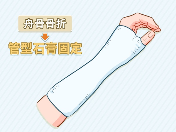 摔倒后手腕这个部位疼痛，警惕舟骨骨折!