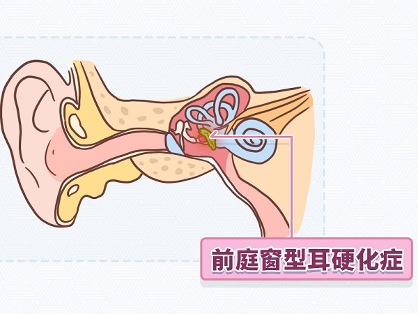 耳硬化症手术有风险吗？术后听力能恢复正常吗？